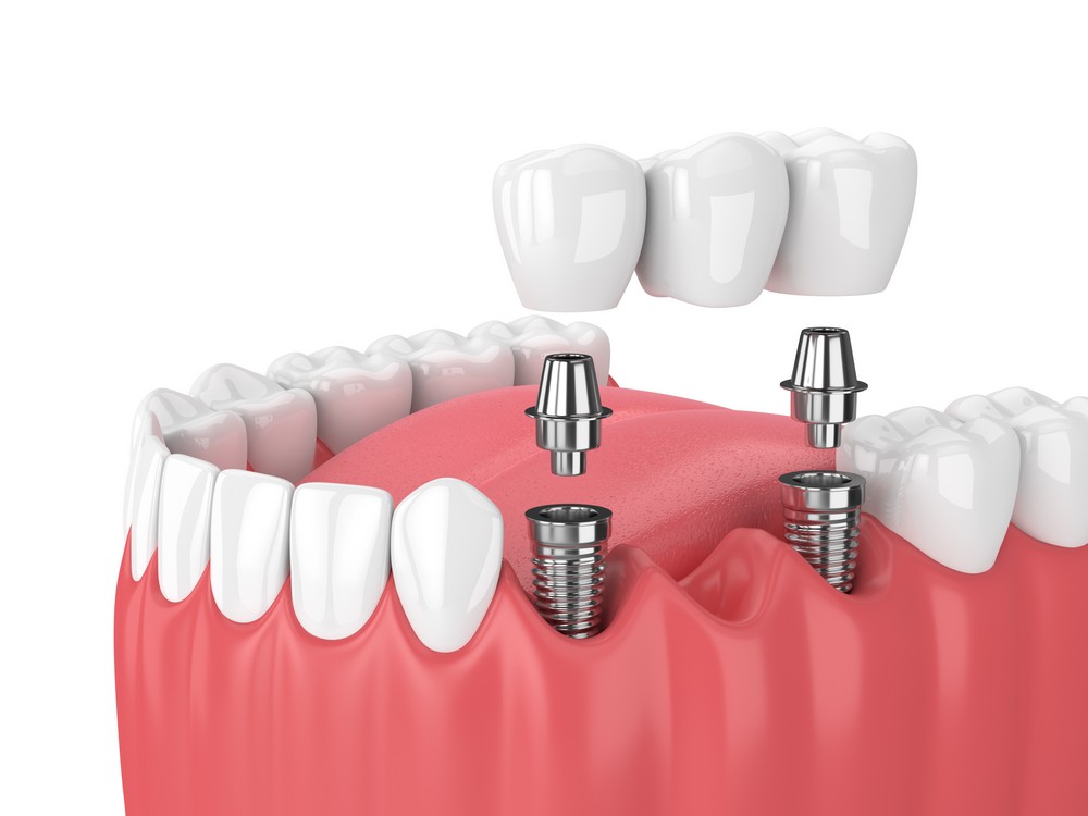 coroane dentare iasi, stomatologie iasi, protetica dentara iasi, klar dental concept iasi