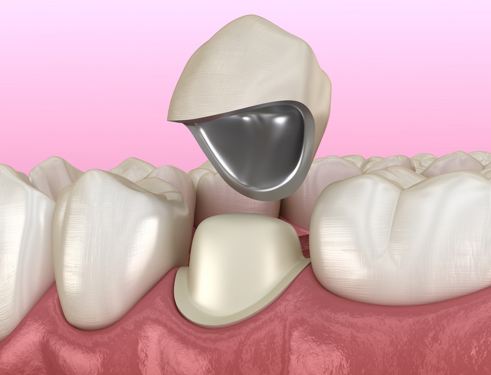 protetica dentara iasi, coroane dentare iasi, stomatologie iasi, klar dental concept iasi