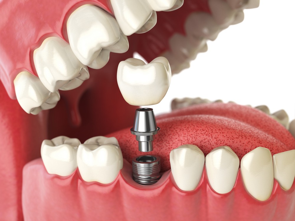 coroane dentare iasi, stomatologie iasi, protetica dentara iasi, klar dental concept iasi