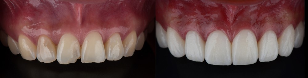 fatete dentare iasi, klar dental concept iasi, stomatologie iasi, albire dentara iasi