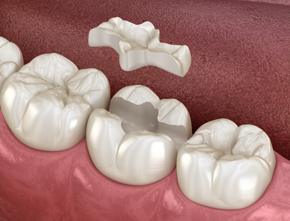 protetica dentara iasi, coroane dentare iasi, stomatologie iasi, klar dental concept iasi