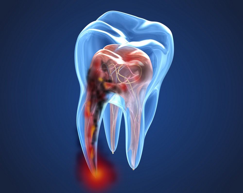 tratament canal iasi, endodontie iasi, cllar dental iasi, stomatologie iasi