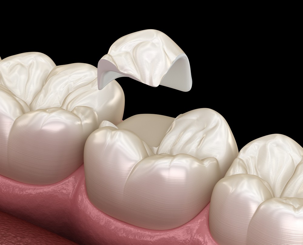 protetica dentara iasi, coroane dentare iasi, stomatologie iasi, klar dental concept iasi