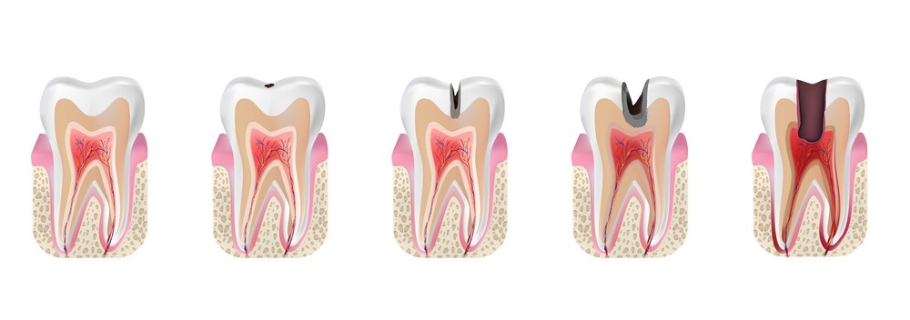 tratament canal iasi, endodontie iasi, klar dental iasi, stomatologie iasi