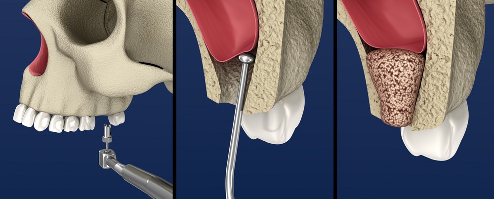 extractie dentara iasi, stomatologie iasi, chirurgie dentara iasi, aditie osoasa iasi