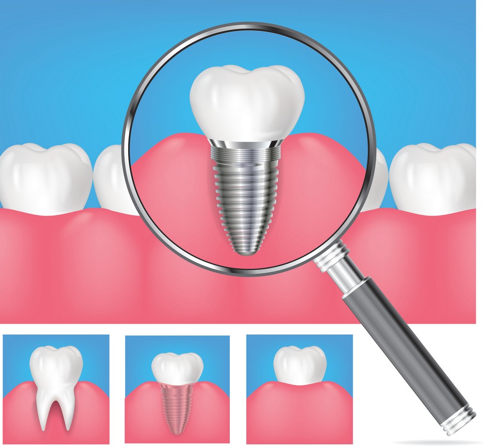 implant dentar iasi, stomatologie iasi, implantologie iasi, klar dental concept iasi